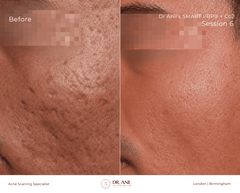Acne Scarring Before and After 6 Sessions of SMART PRP wtih Dr Anil Acne Scarring specialist in london in london