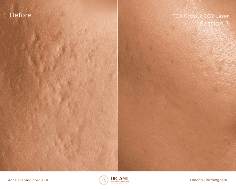 Acne Scarring Before and After TCA cross and Co2 laser with Dr Anil Dermatologist in london