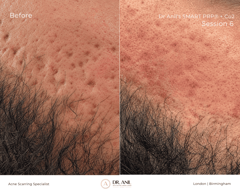Acne Scarring Before and After 6 Sessions of SMART PRP wtih Dr Anil Acne Scarring specialist in london in london