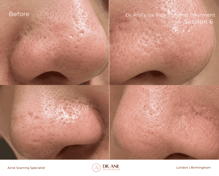 Acne Scarring Before and After TCA cross with Dr Anil Dermatologist in london