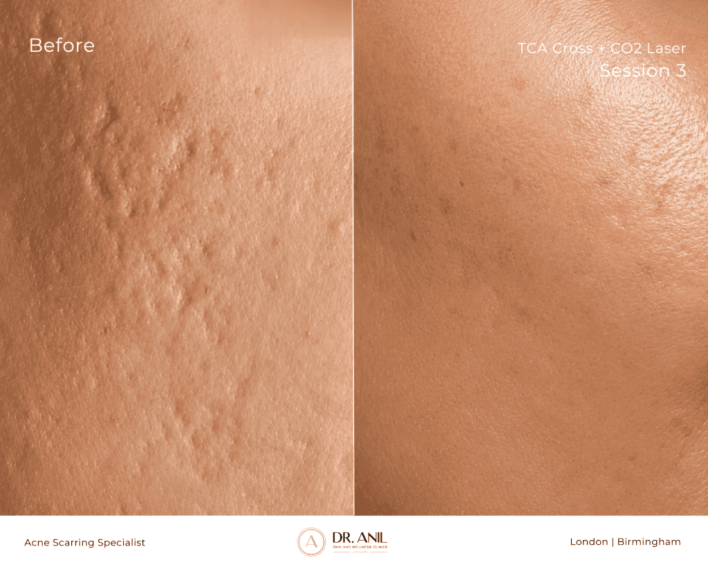 Acne Scarring Before and After TCA cross and Co2 laser with Dr Anil Dermatologist in london