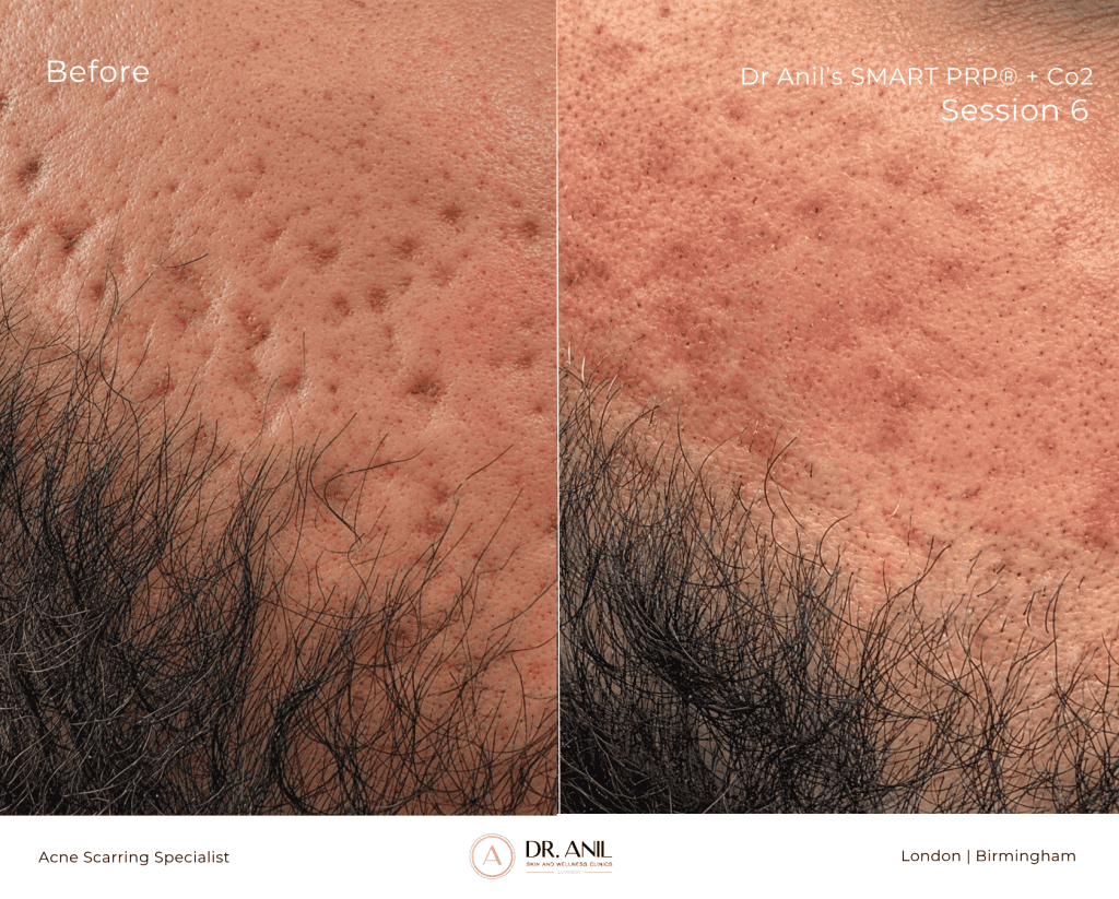 Acne Scarring Before and After 6 Sessions of SMART PRP wtih Dr Anil Acne Scarring specialist in london in london